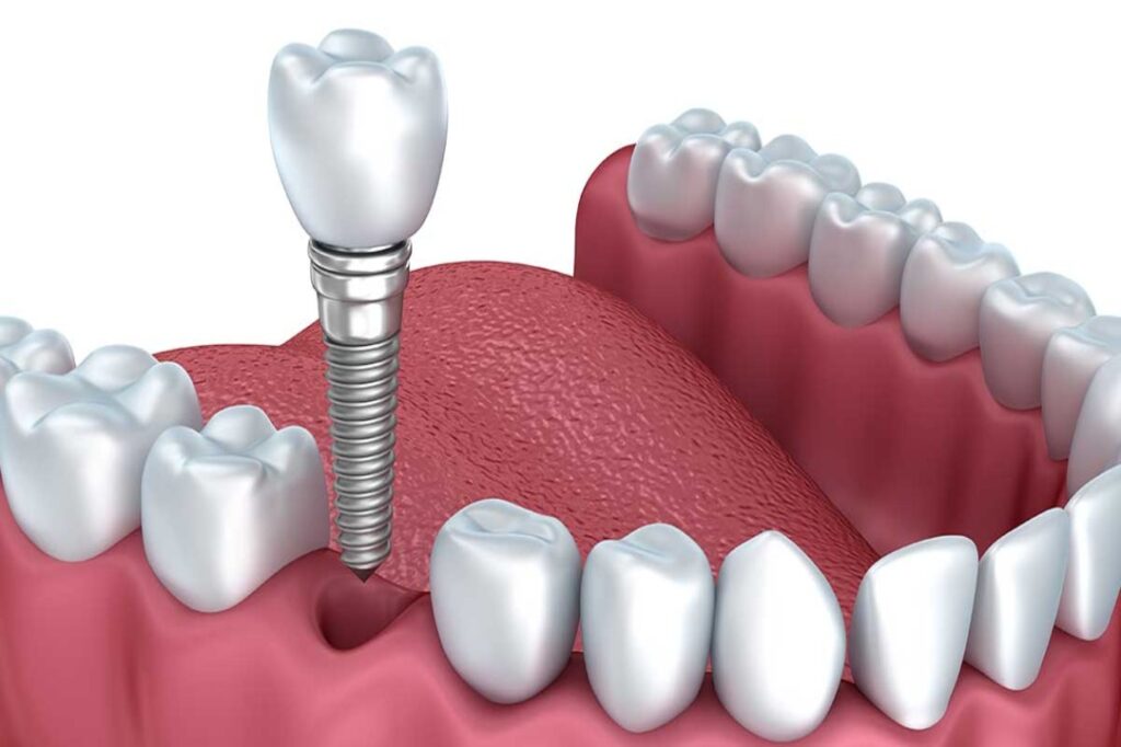 SINGLE UNIT IMPLANTS - Dental